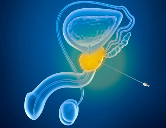 BIOPSIA PROTÁTICA. Urología Ciudad Real